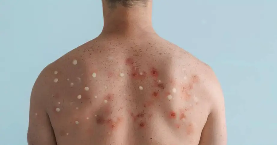 Tomato flu shows similar symptoms to Monkeypox.