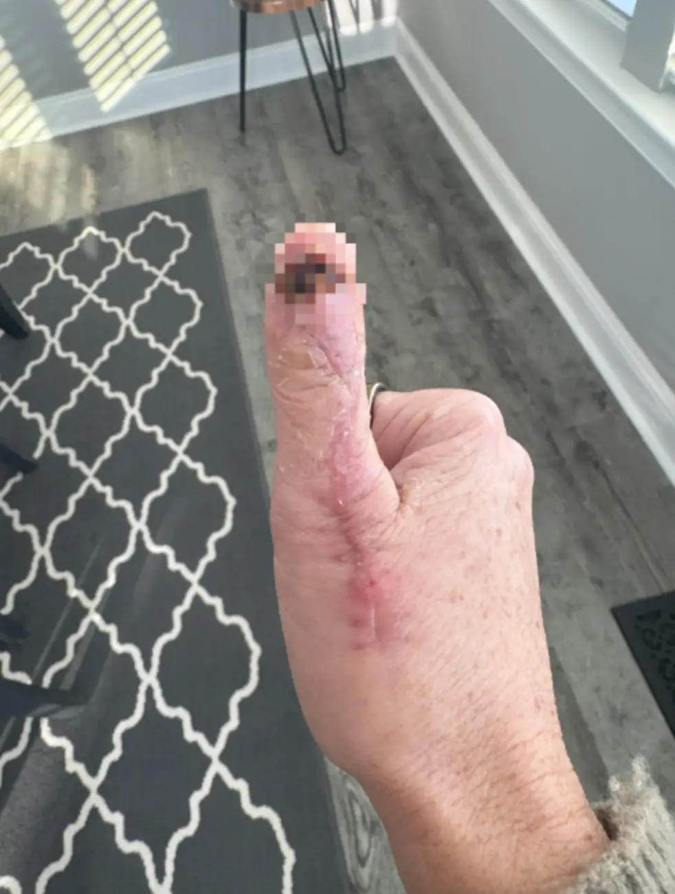 Michelle's post-surgery scar (Kennedy News and Media)