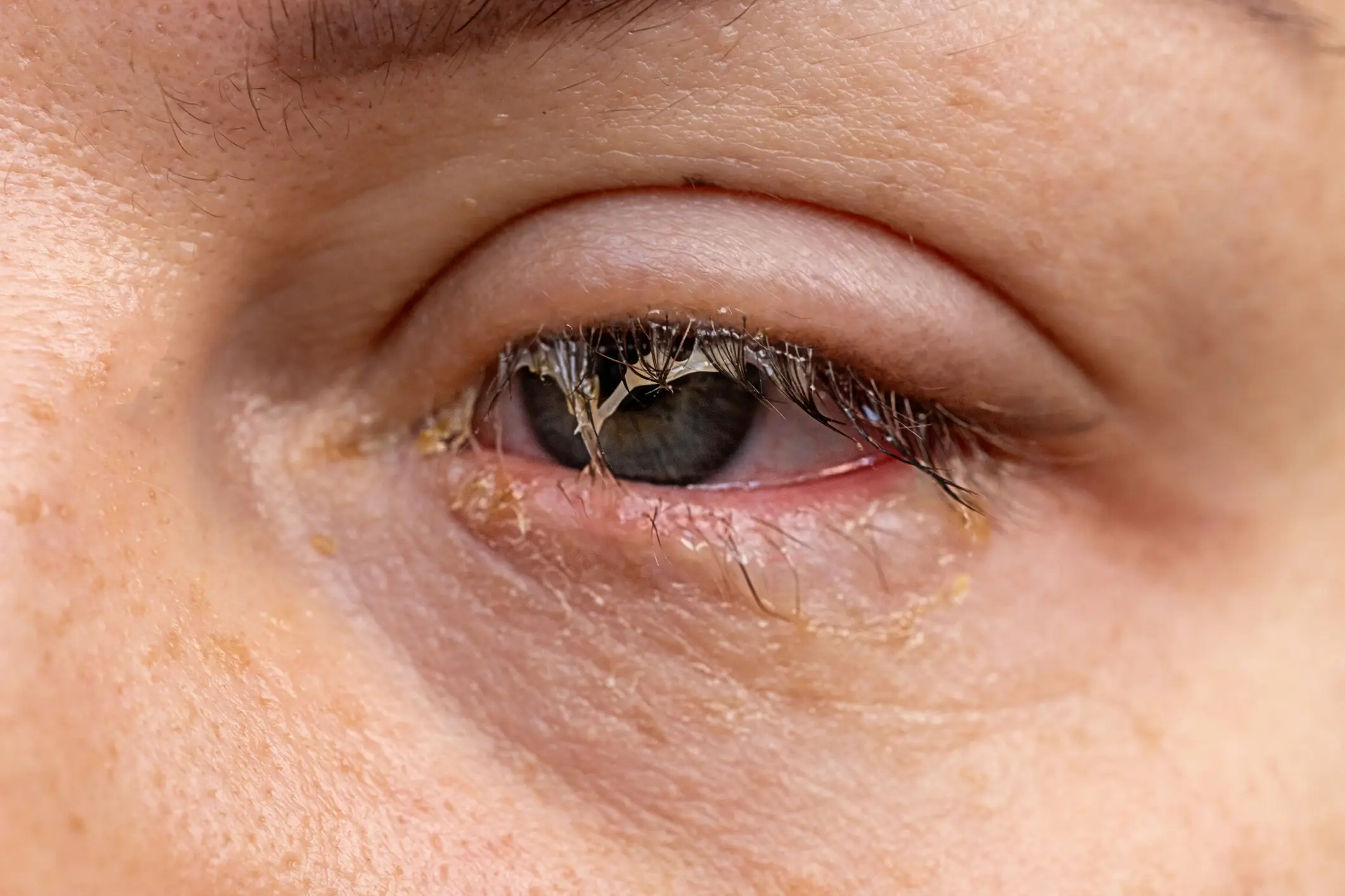 Uveitis needs quick treatment (Getty Stock Images)