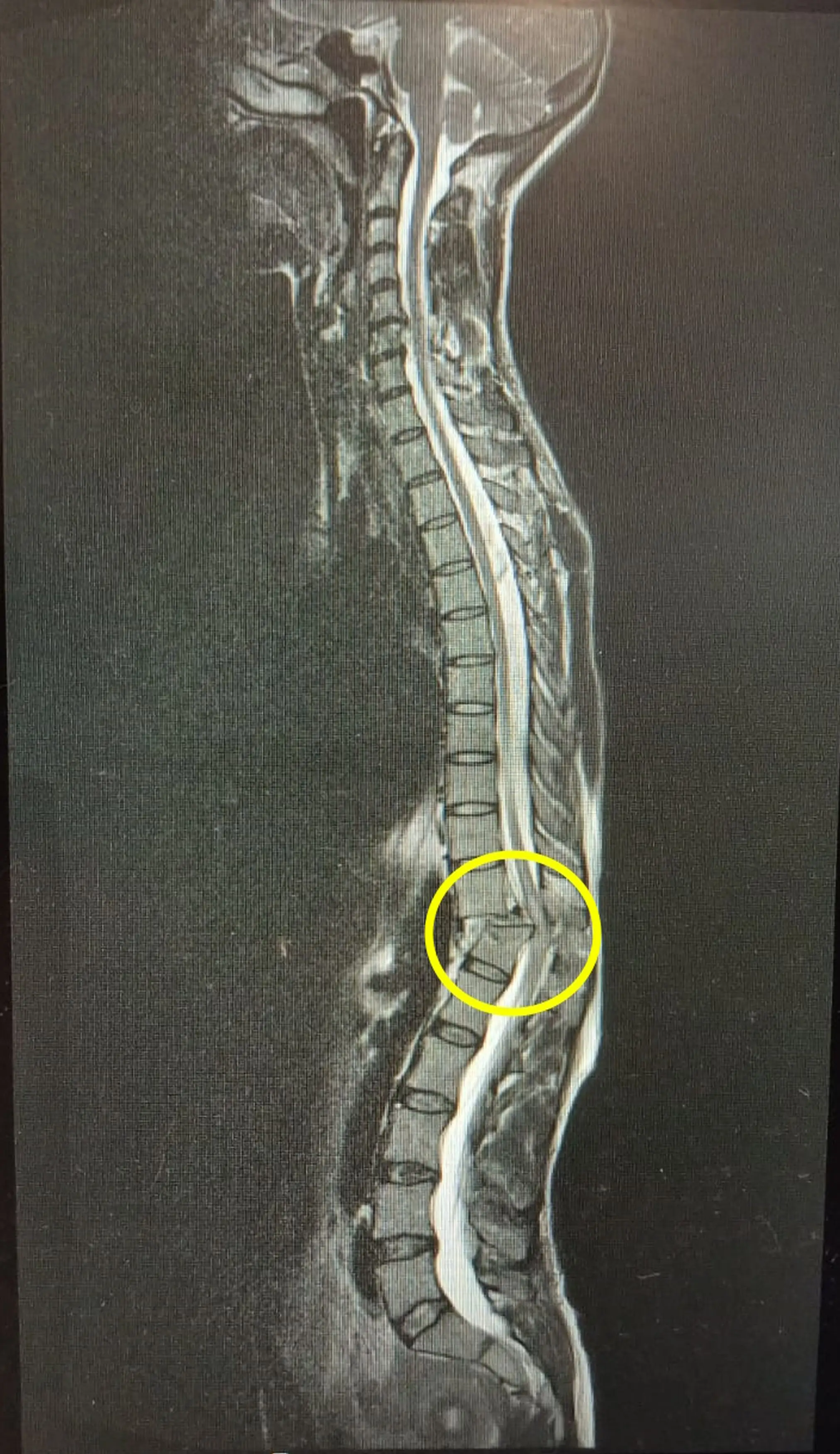 The mum-of-two is paralysed from the waist down (Kennedy News and Media)