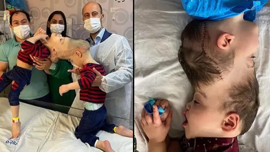 Conjoined Twins With Fused Brains Separated By UK Doctor In 'Remarkable Achievement'