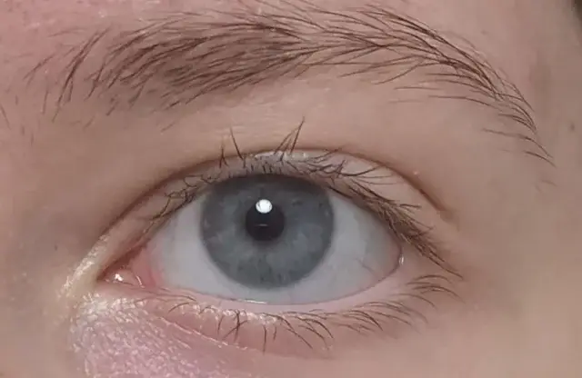 The poster's eyes taken shortly before (Reddit)