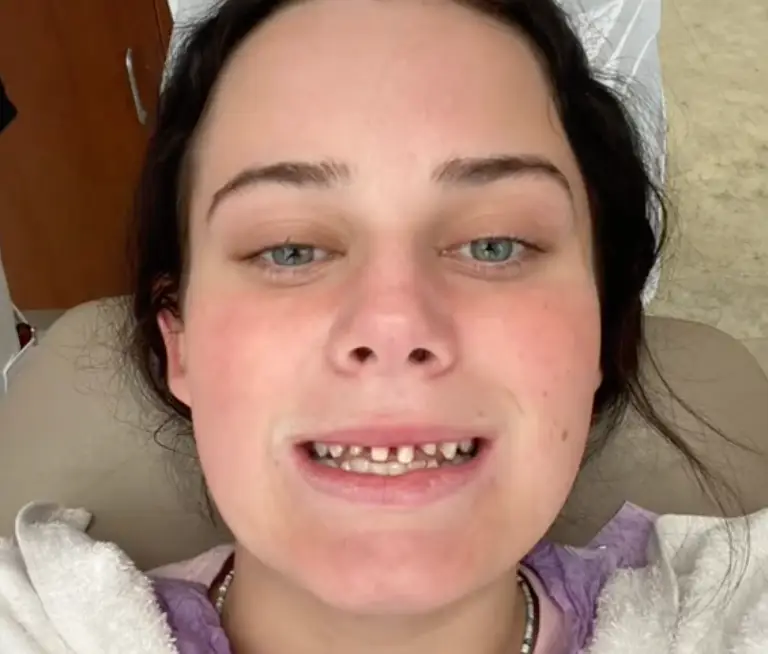 Caitlyn had mistakenly had her teeth filed down, and looked in the mirror to see this. (@caitlynweld/TikTok)