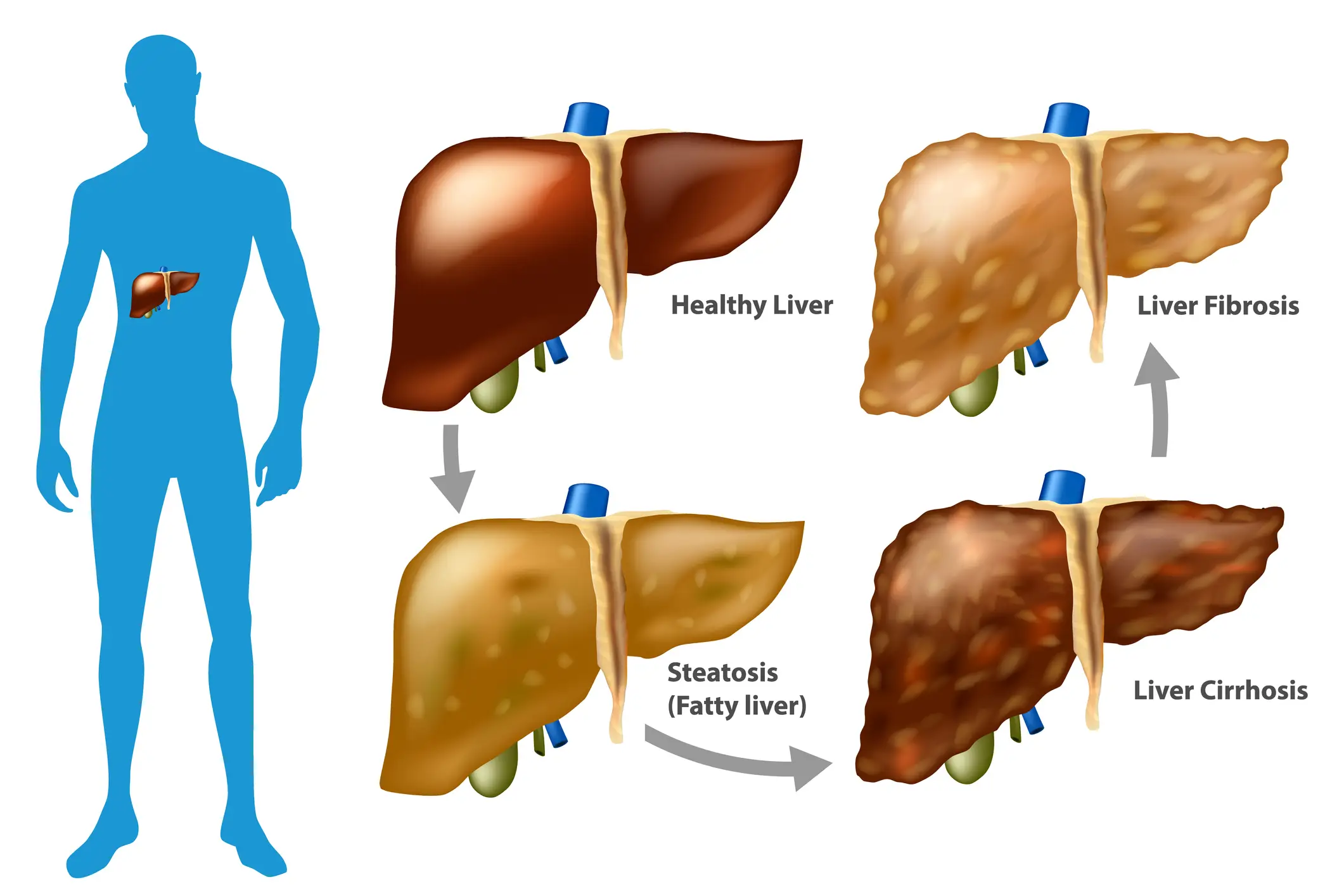 Researchers found boosts to the liver health of the participants (Getty Stock Image)