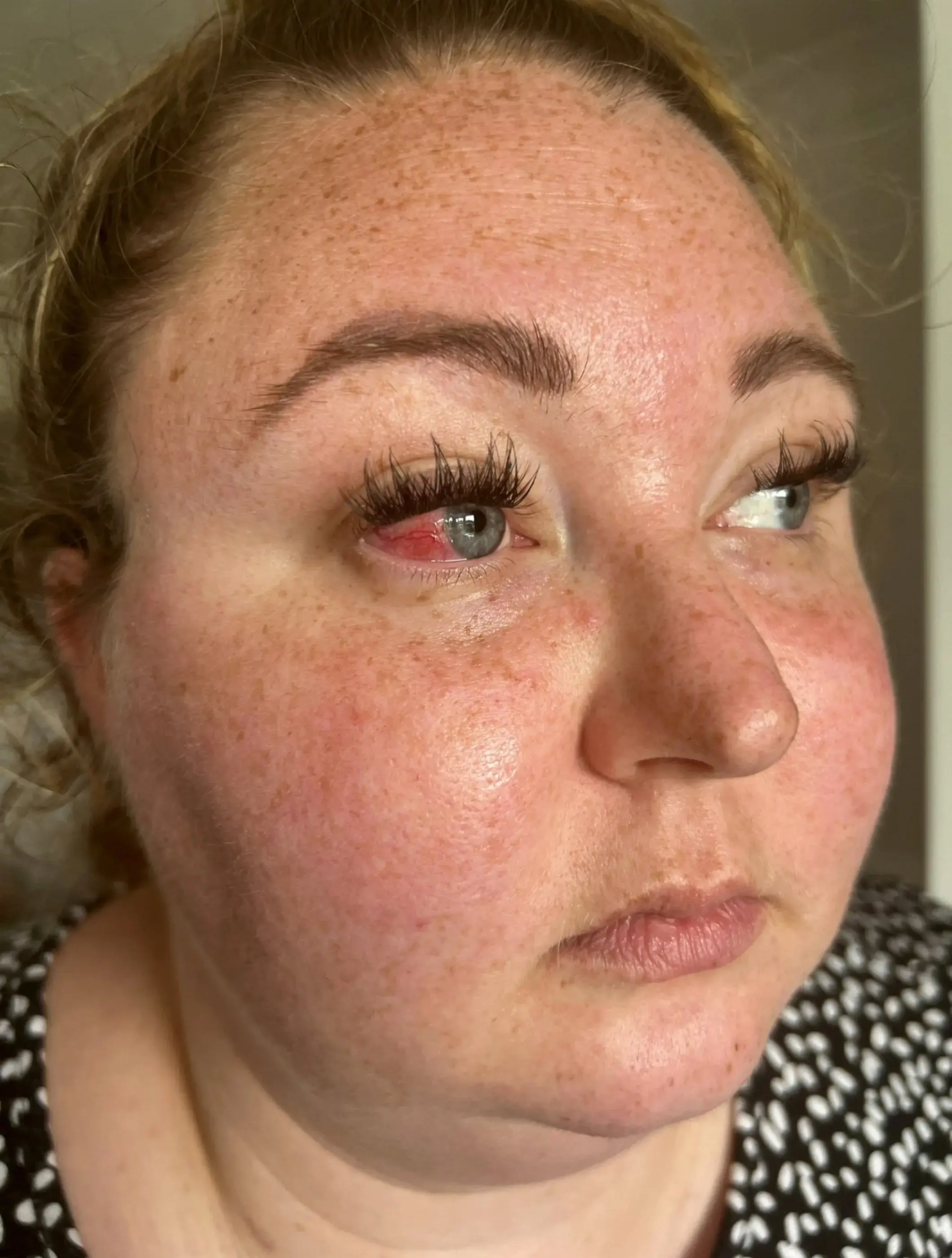 After she was diagnosed doctors told Holly her eye could explode if they didn't remove it. (SWNS)