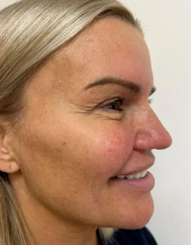 Kerry has explained why she won't get anymore surgery on her nose. (Pall Mall Medical)