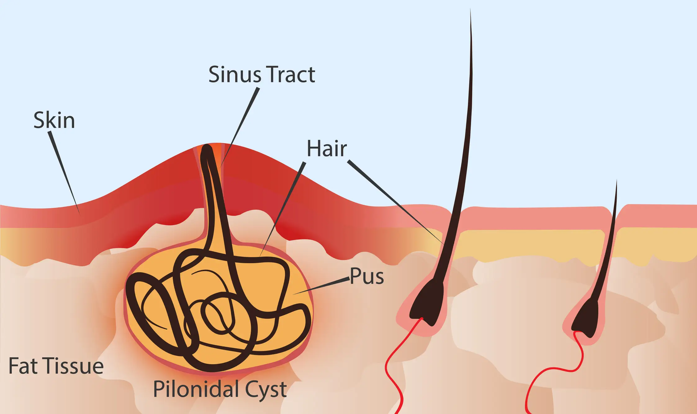 Around 26 in 100,000 people have pilonidal cysts (Getty Stock Images)