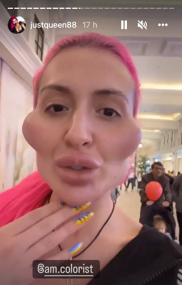 Anastasia Pokreshchuk is known for having the 'world's biggest cheeks'.