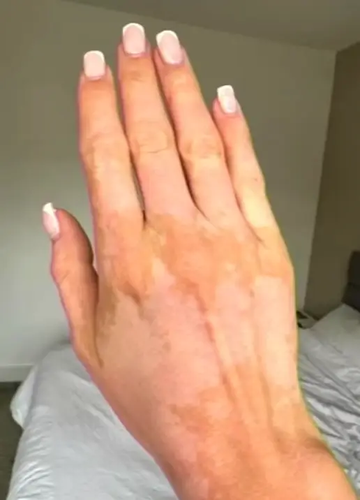 Chelsea was diagnosed when she was 28 (Chelsea Tantum)