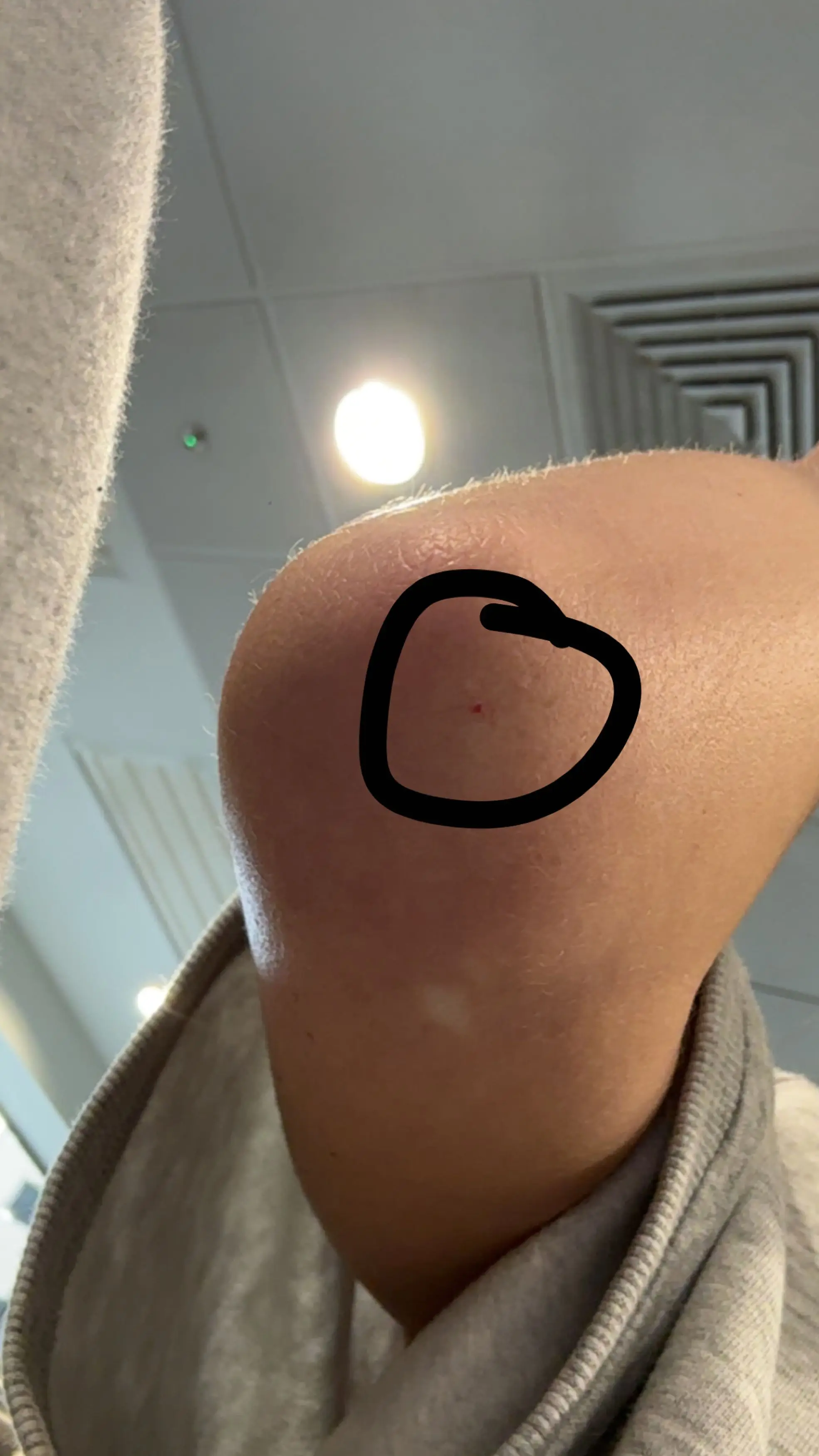 Kacey said she thinks she was injected in her elbow (Kennedy)