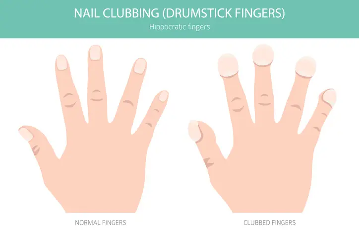 Nail clubbing could be a sign of lung cancer (Getty Stock Images)