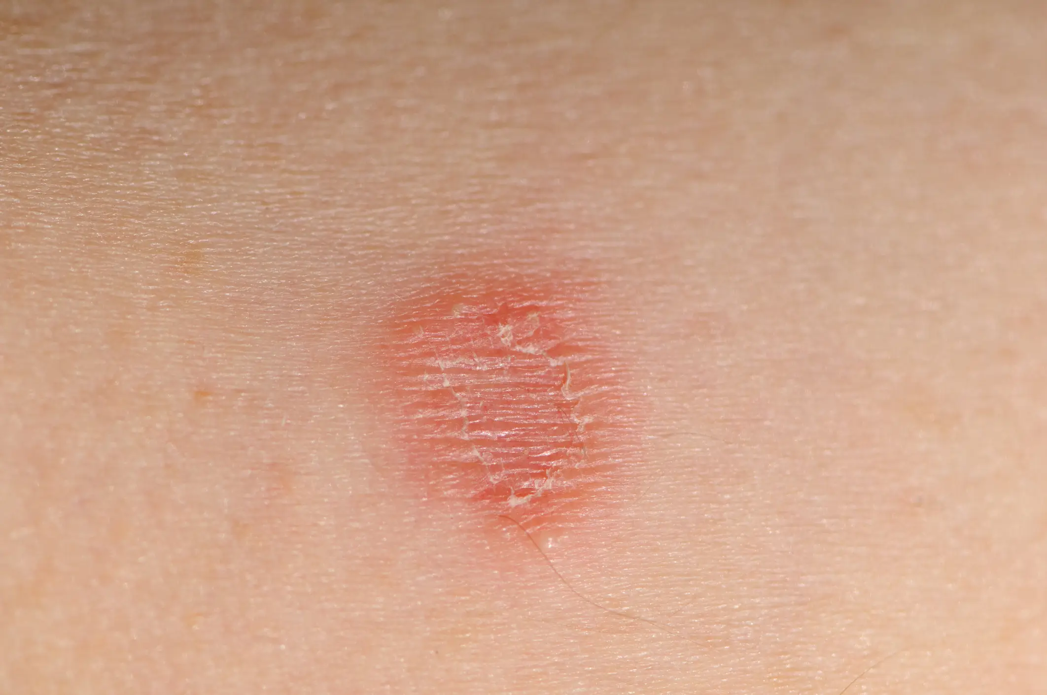 A ringworm rash looks something like this (Getty Stock Photo)