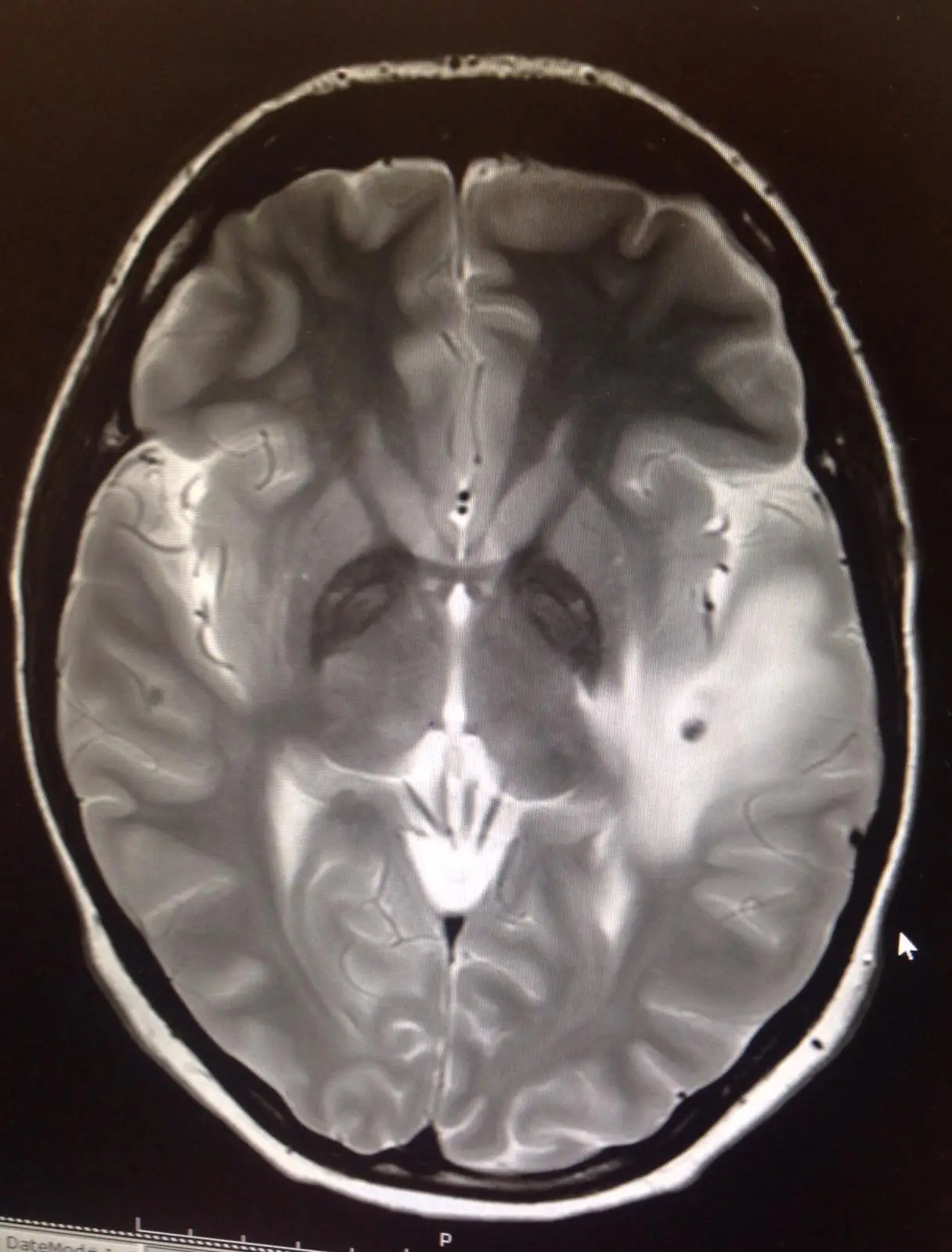 A brain scan revealed she had developed dozens of parasites (PA Real Life)