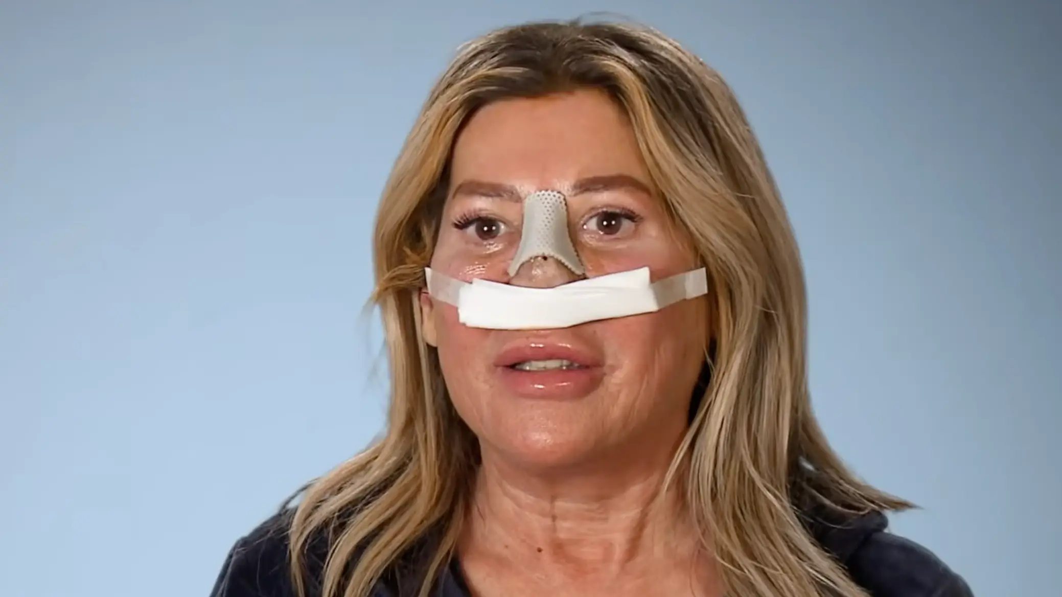 'Party girl' shares new nose after drug abuse caused it to collapse in on itself