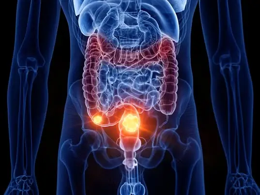 The condition has been linked to bowel cancer in UK youngsters (Getty Stock Image)