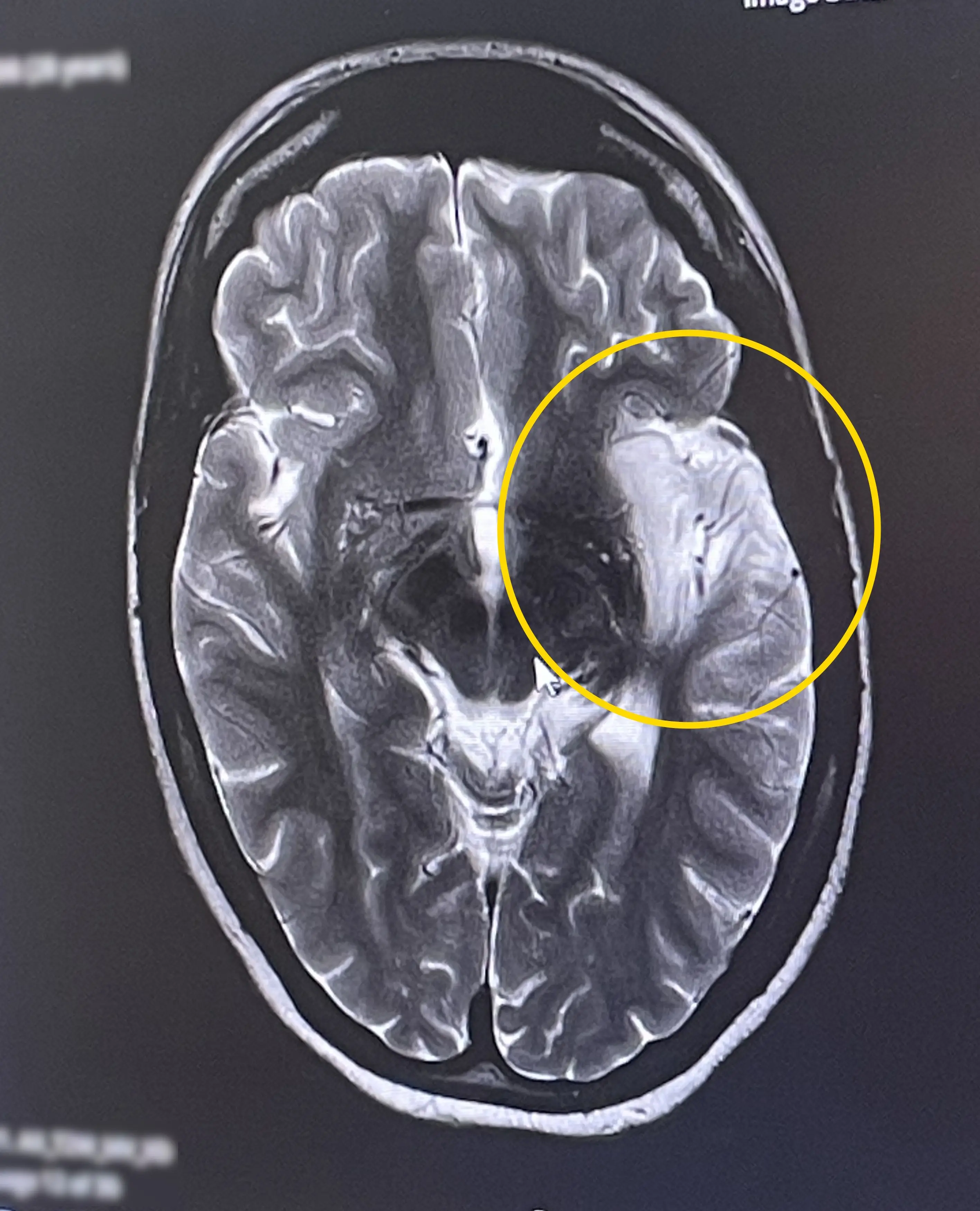 The swelling of Georgina's brain (Kennedy News and Media)
