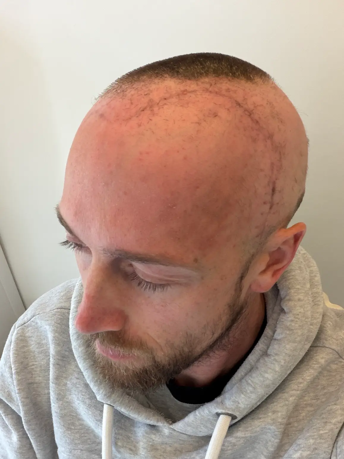 Matt had surgery to remove a percentage of the tumour in February of this year (Supplied)