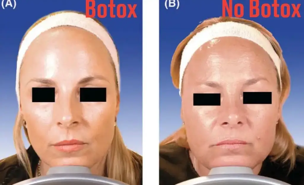 Dr Binder followed up with the twins six years later to see their results (American Society for Dermatologic Surgery)