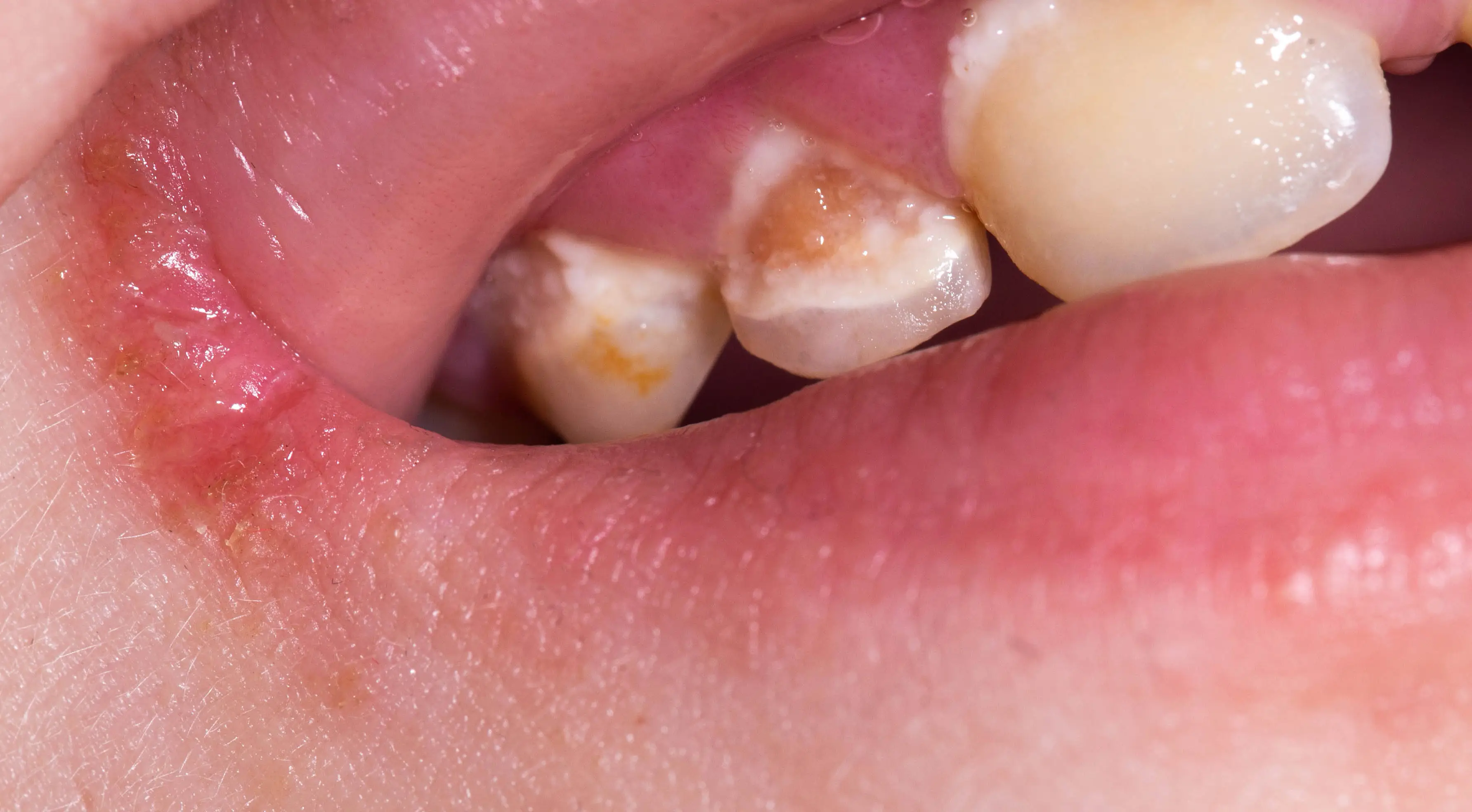 MIH damages the crucial enamel coating the teeth (Getty Stock)