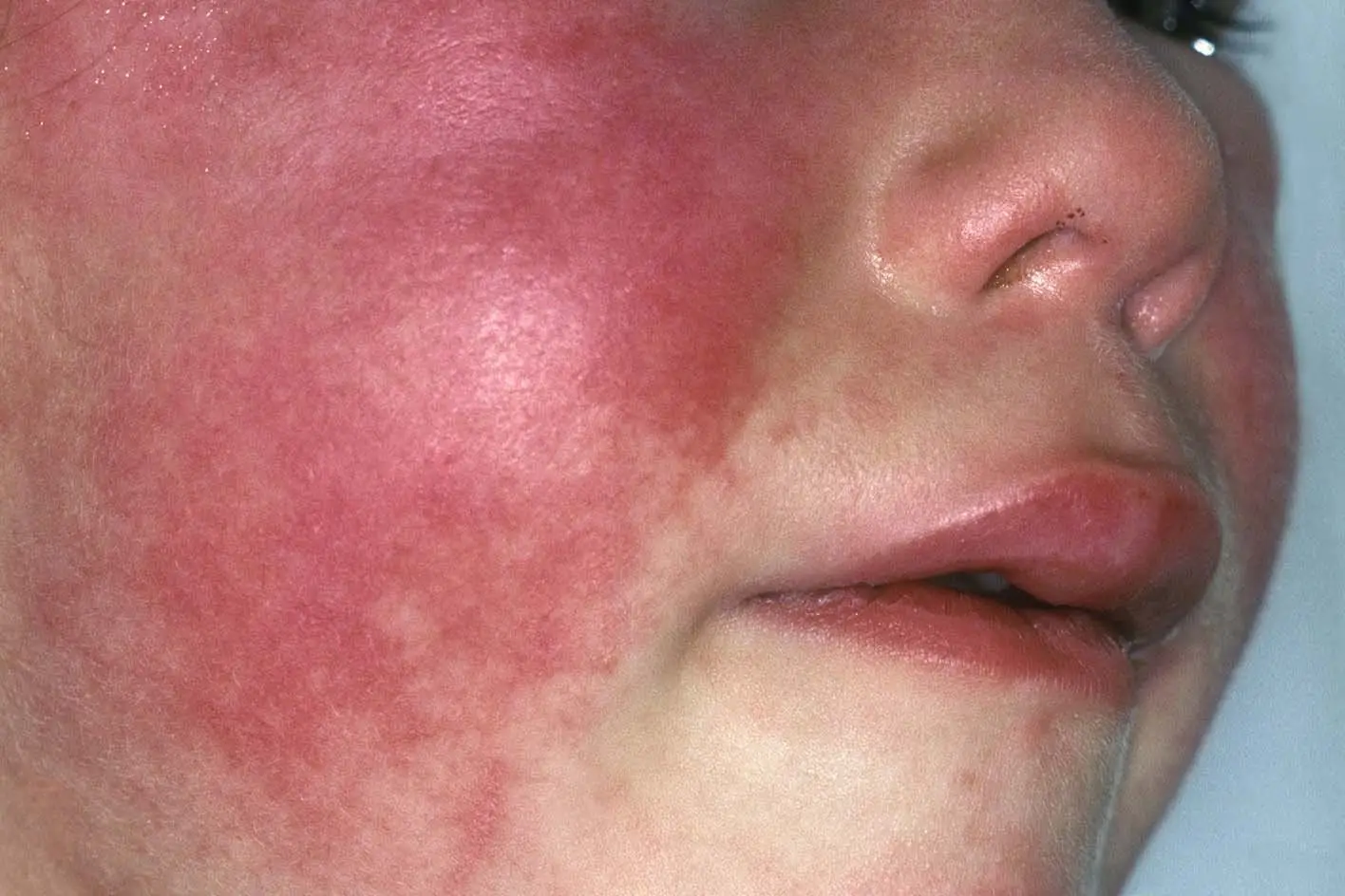 Symptoms of scarlet fever (NHS)