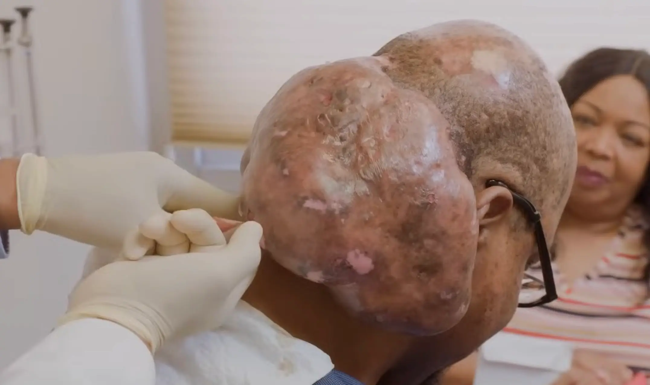Arlin had a 'cantaloupe-sized' tumour on the back of his head for more than a decade (TLC)