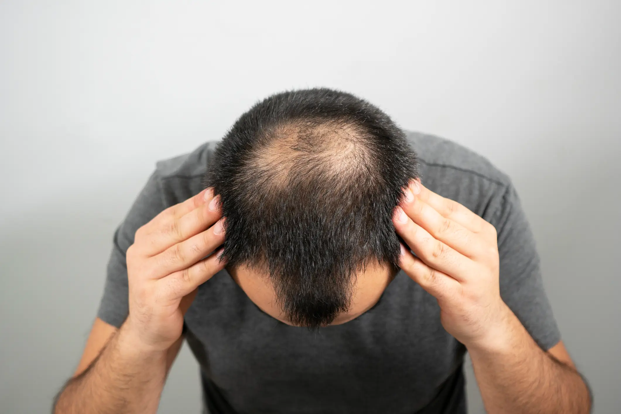 Losing your hair can be a hard thing to process (Getty Stock Images)