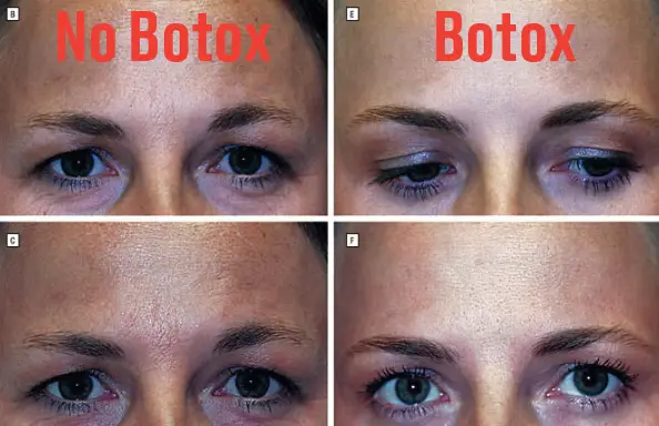 The twin who got Botox over the 20-year period looked a lot more youthful than her sister (American Medical Association)