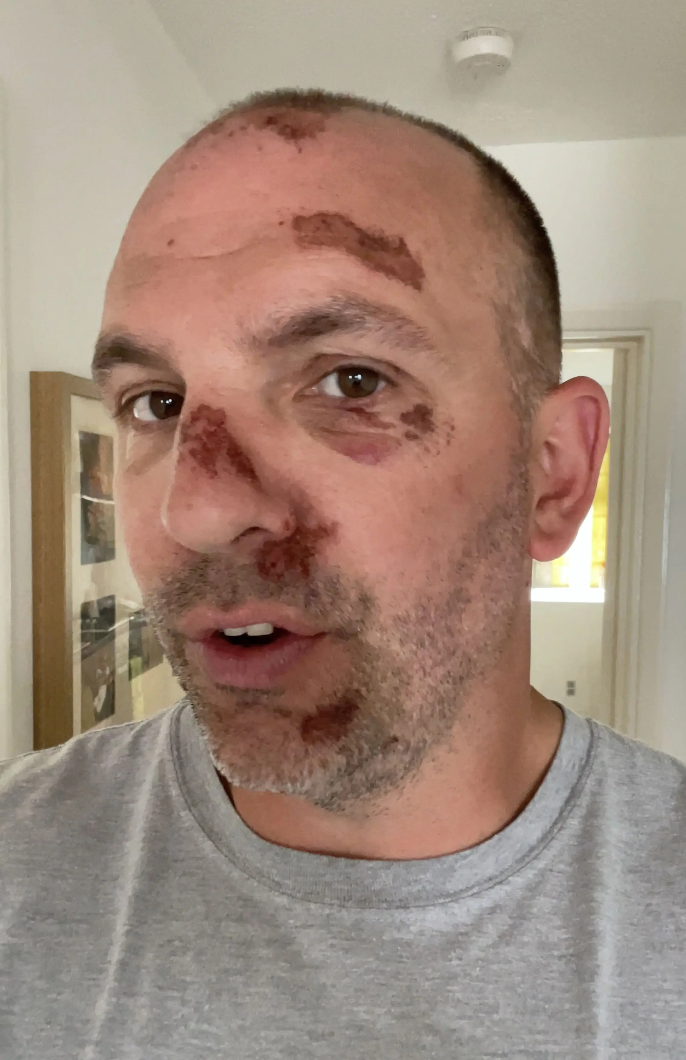 Richard Garbas said 'sod them' after his own e-scooter crash (Kennedy)