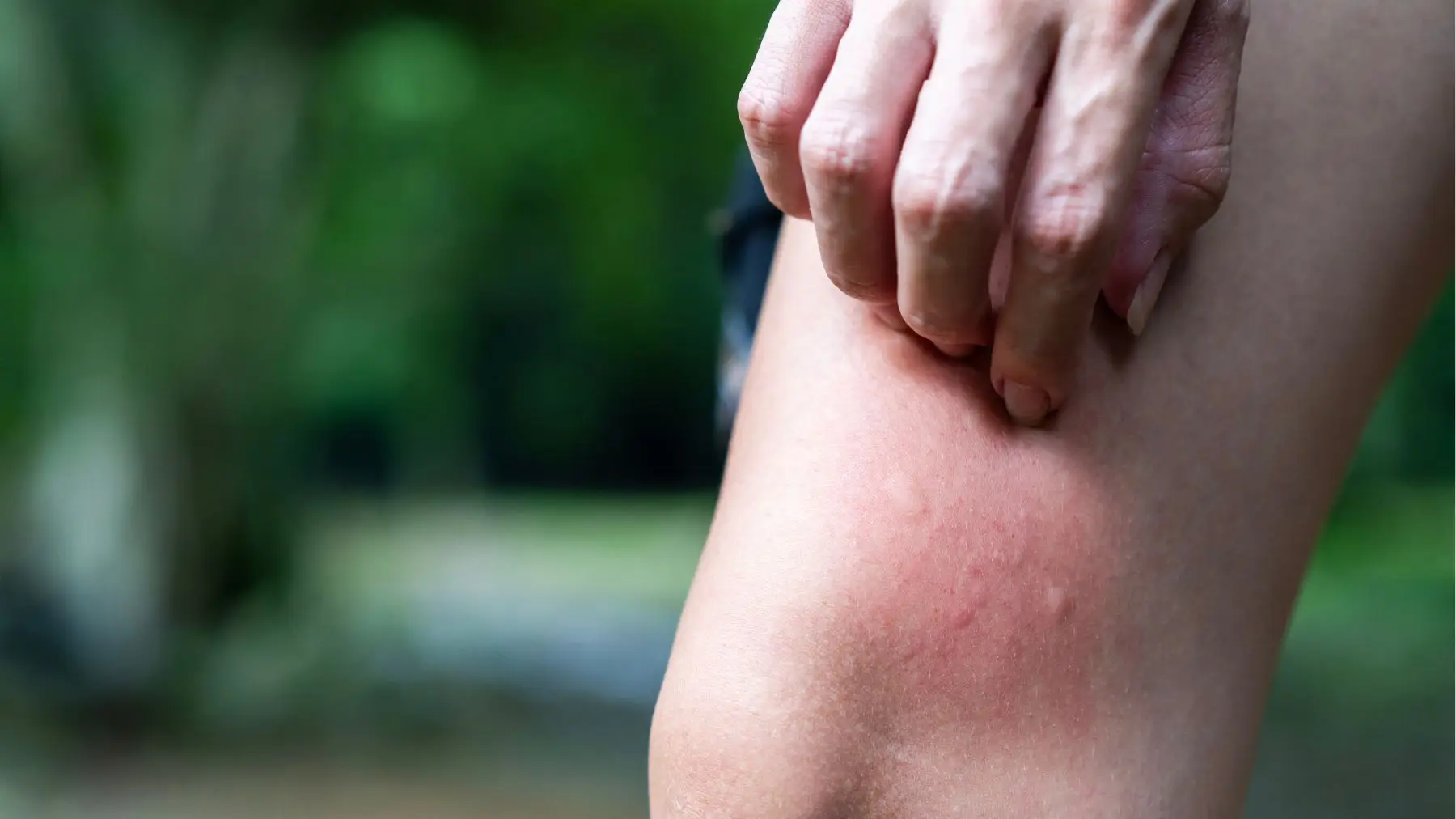 Itchy mosquito bites (Witthaya Prasongsin/Getty Images)