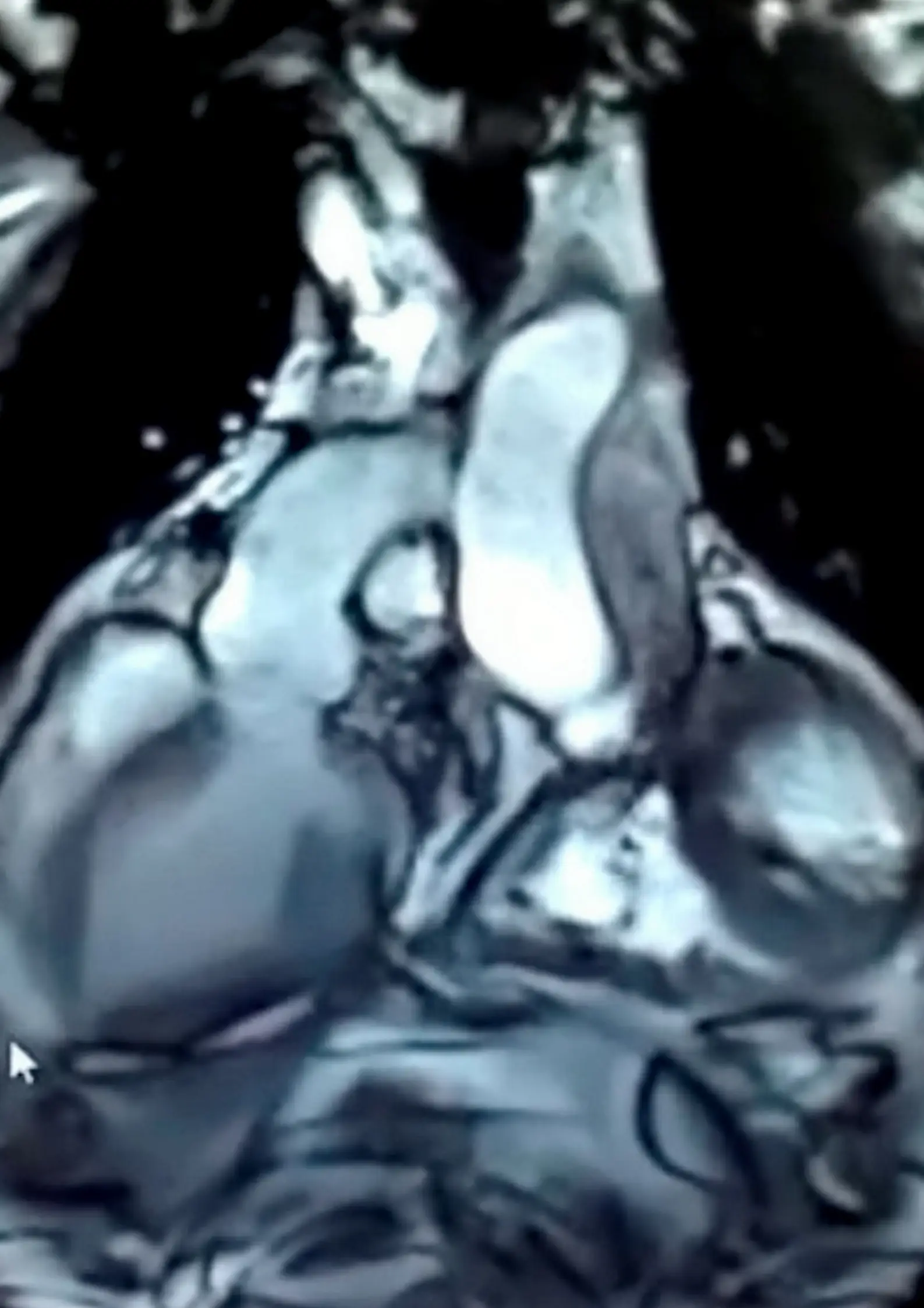 The healthy donor heart is working in tandem with the diseased one.