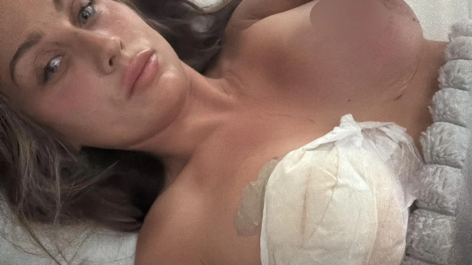 Chloe Roiser has been left fighting to keep her breast after developing tissue necrosis (SWNS)