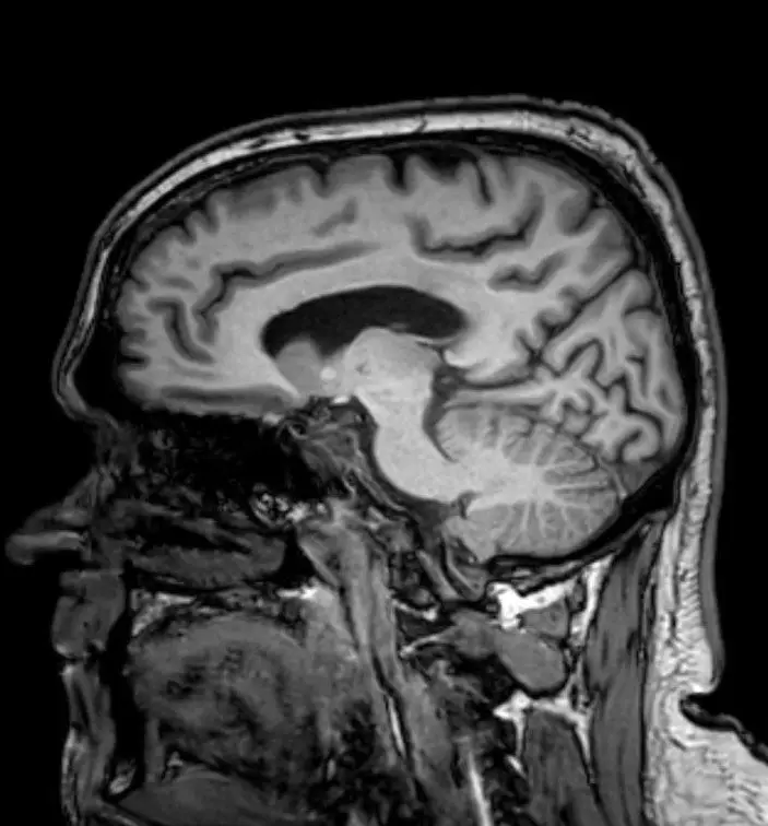 Jamie's CT scan revealed the brain tumour (SWNS)