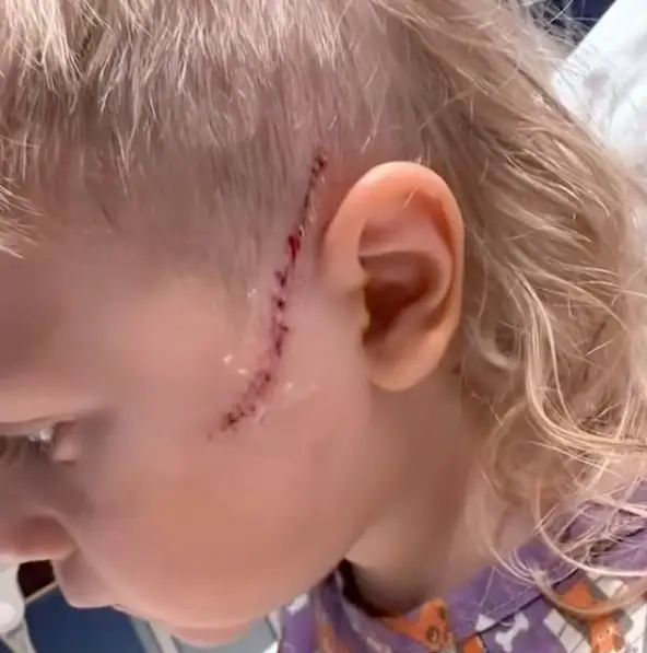 The gash on Cyler's face (KETV NewsWatch 7)