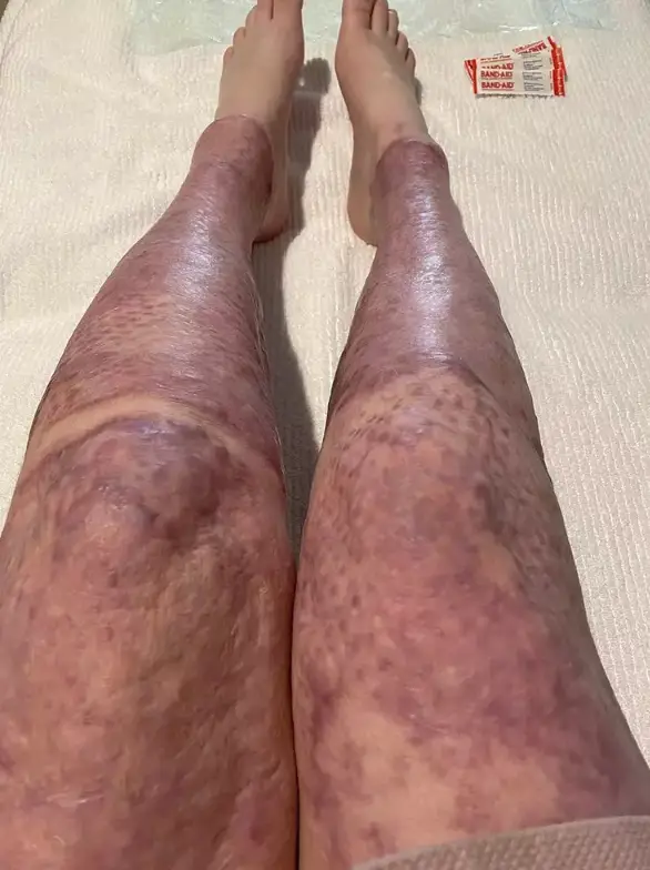 70 percent of Stephanie's body was covered in full-thickness burns (Instagram/@stephaniecoral96)