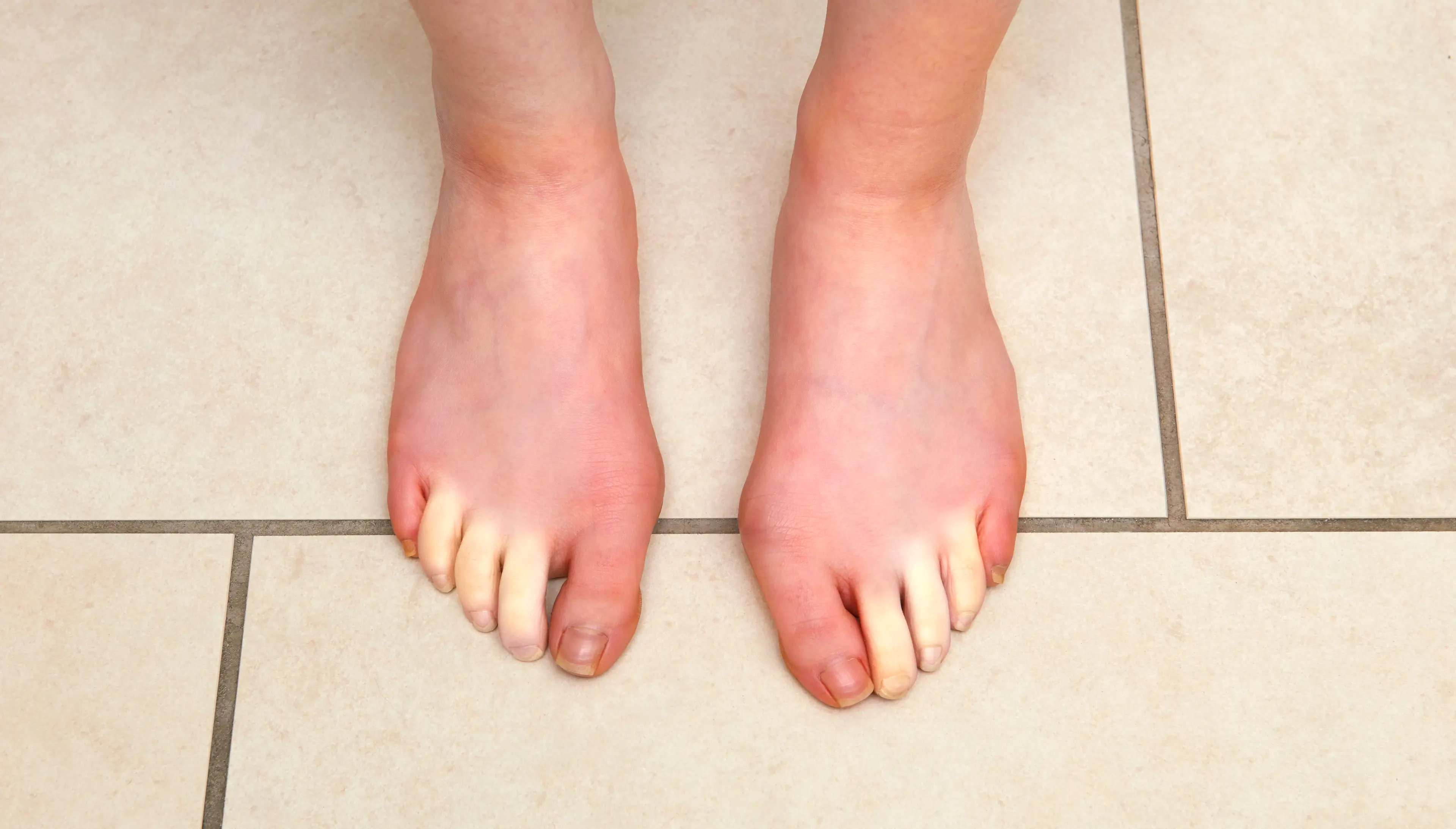 Raynaud's disease impacts your feet as well as hands (Getty Stock Images)
