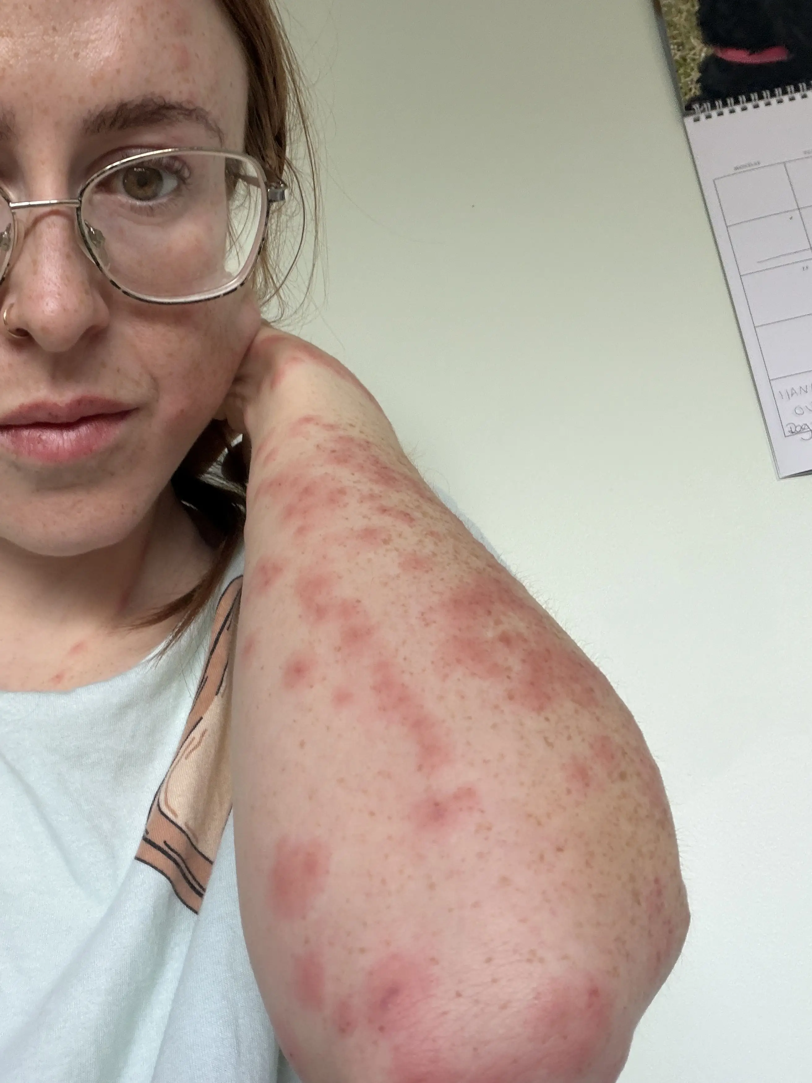 Hannah was covered in bites (Kennedy News and Media)