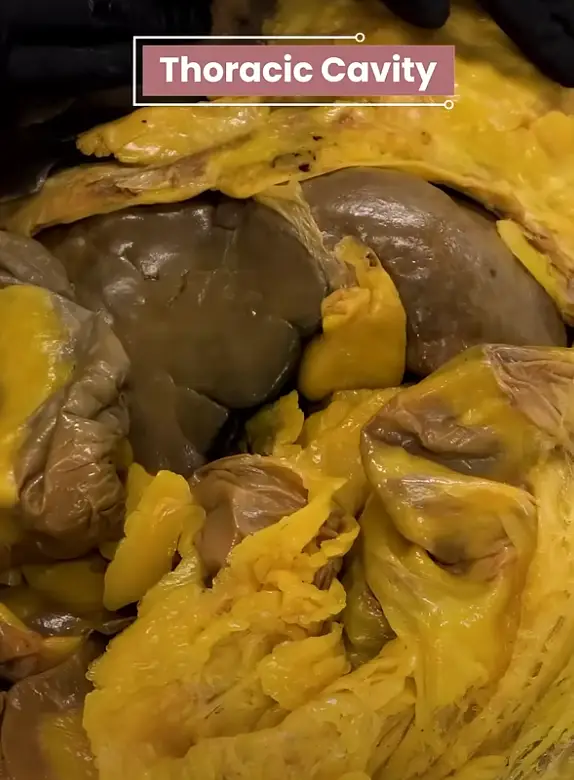 Fat can be seen engulfing the vital organs (YouTube/@theanatomylab)