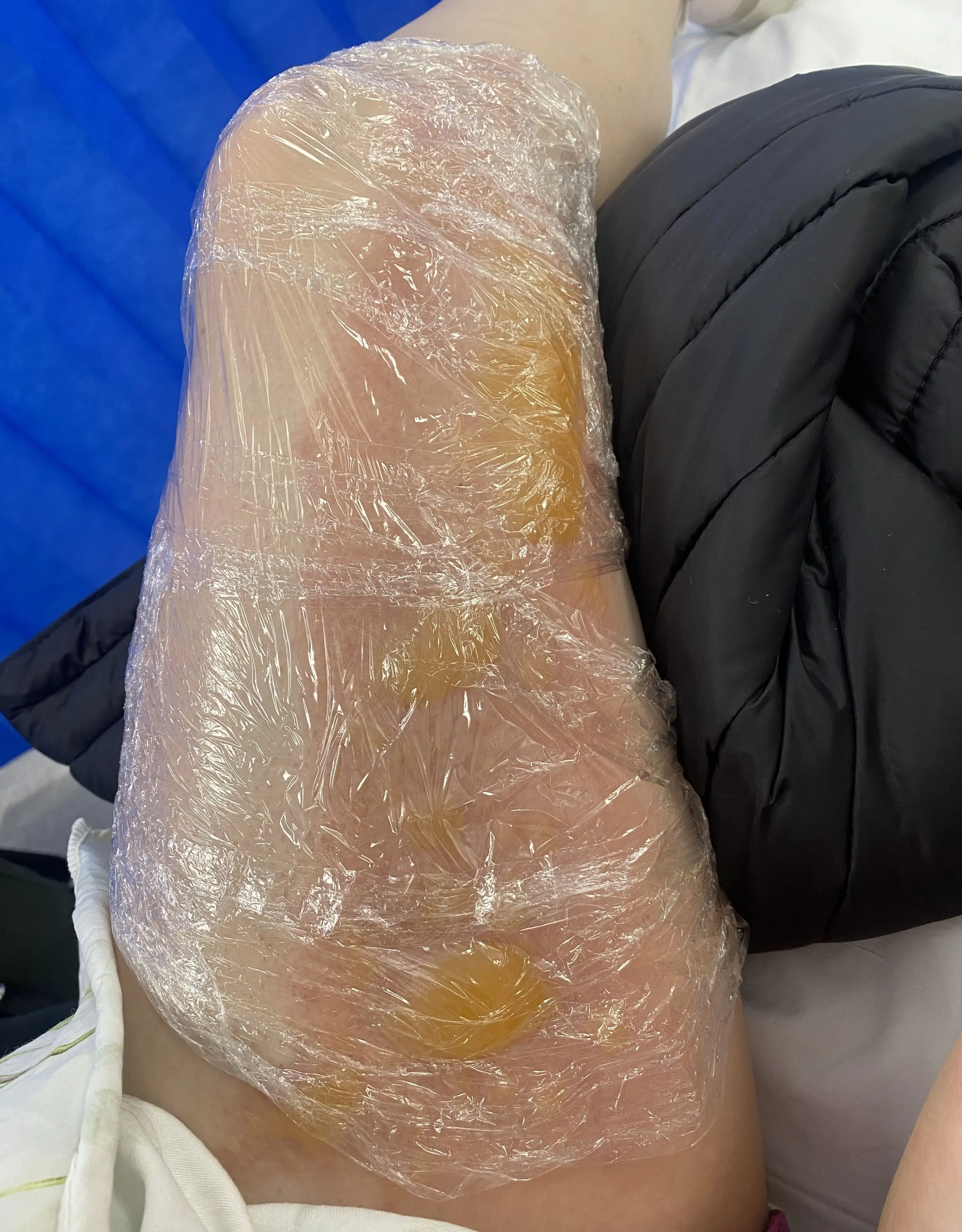 She had her blisters cling filmed before getting them burst (Kennedy News and Media)