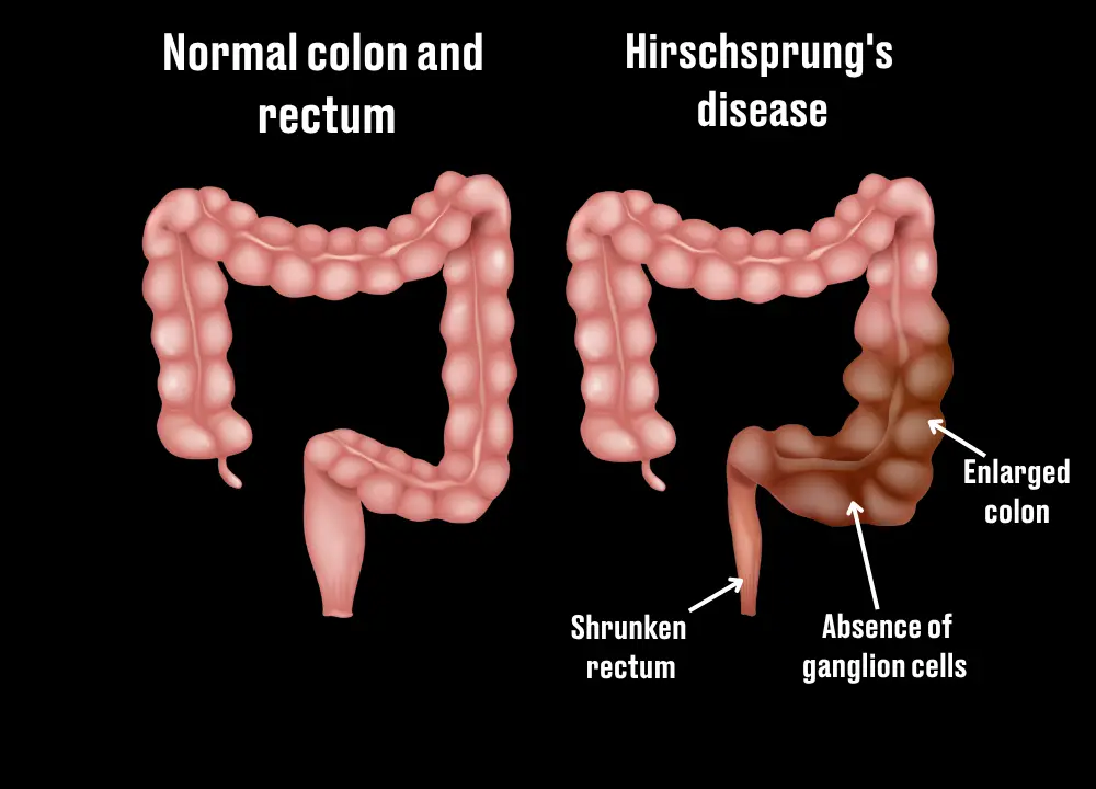 Hirschsprung disease is a rare congenital condition present at birth (LADbible/Getty Stock Images)