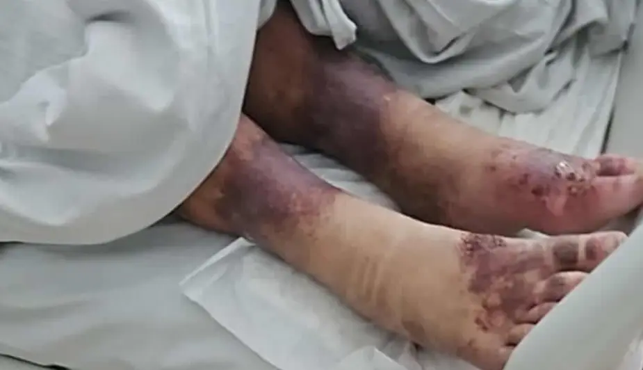 Doctors say the 42-year-old could have been days away from death due to an infection (Pomagan.pl)