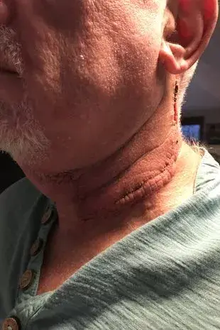 The cancer survivor underwent a gruelling 10-hour operation following his diagnosis (Chris Byrne)