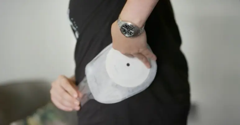 Josh's urine filters into a bag (BBC)