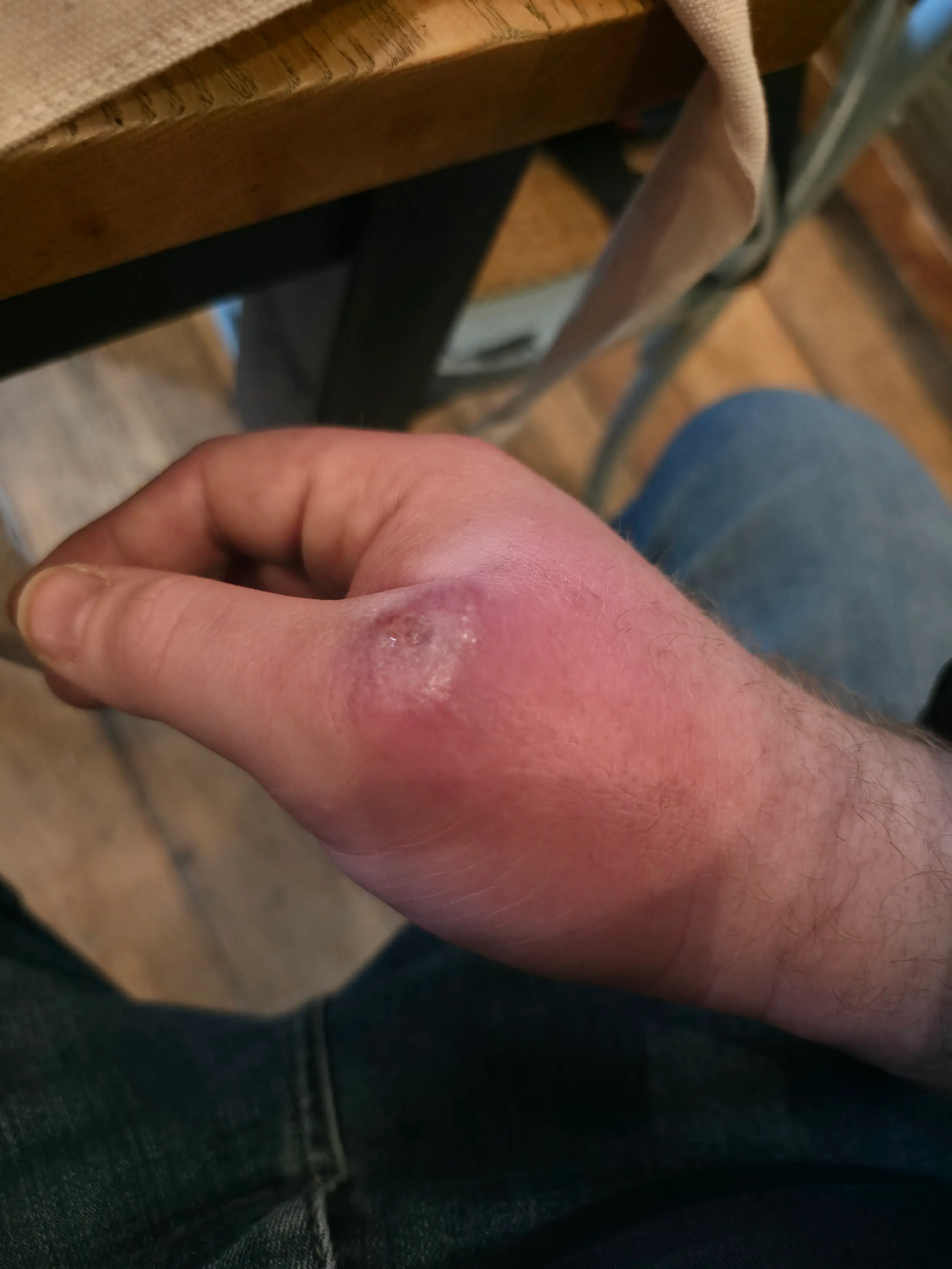 Chris' hand swelled after the bite (SWNS)