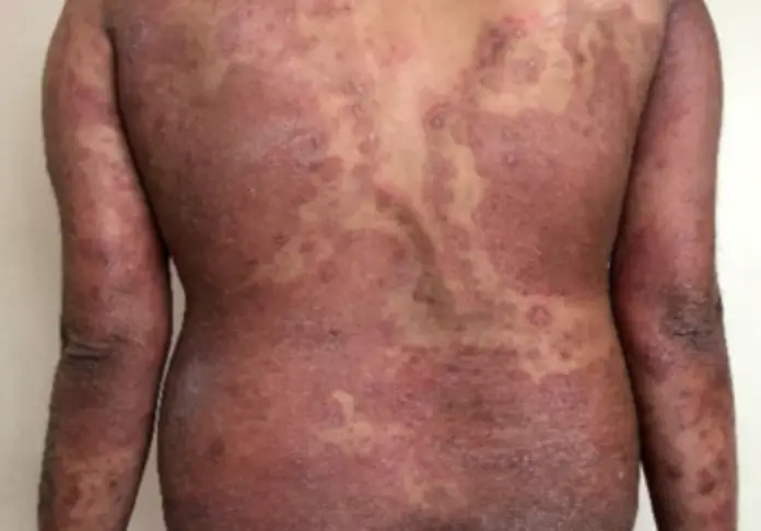 The fungus spreads fairly easily, as experts expect numbers to rise (MDPI)