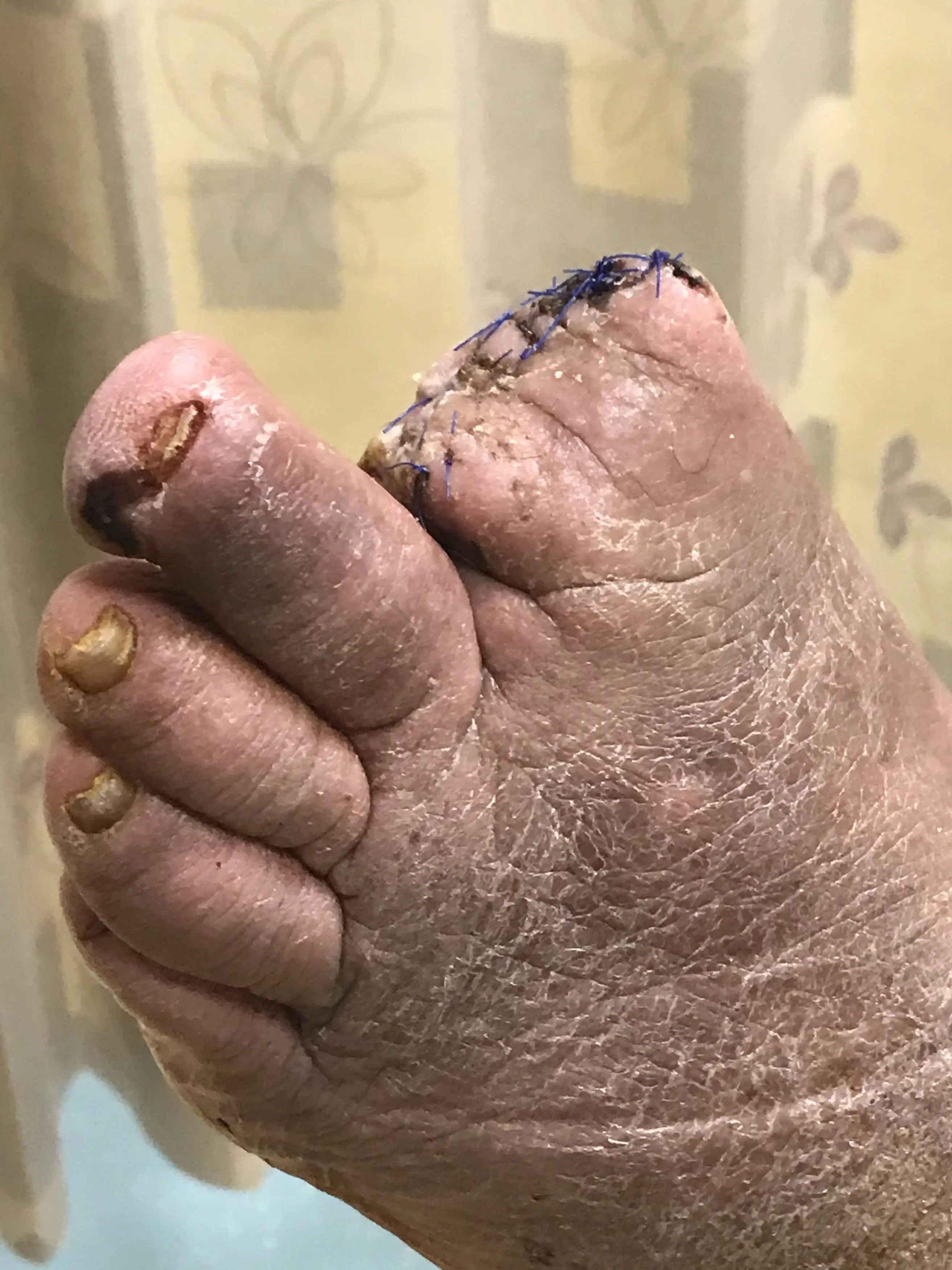Doctors were amputating his toes but the pain wasn't going away (Kennedy News and Media)