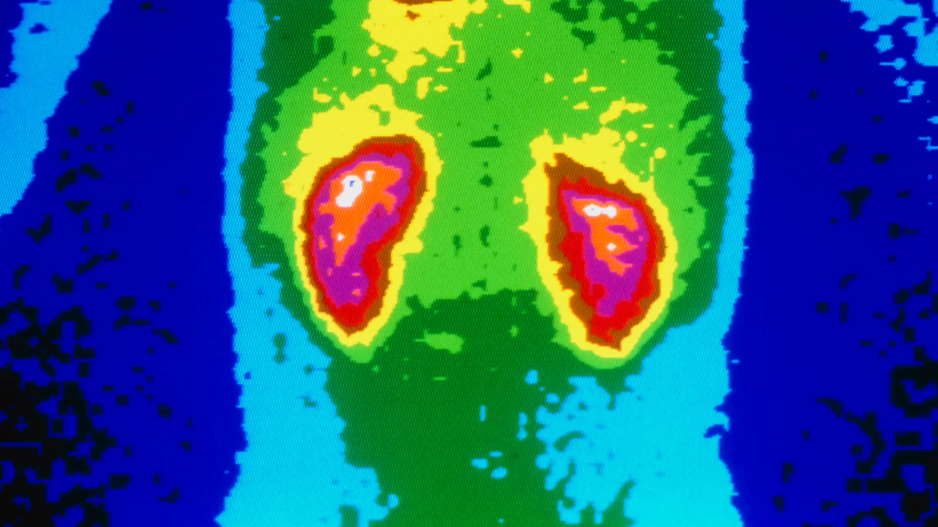 Man faced serious consequences after taking 1,176 ibuprofen in one month