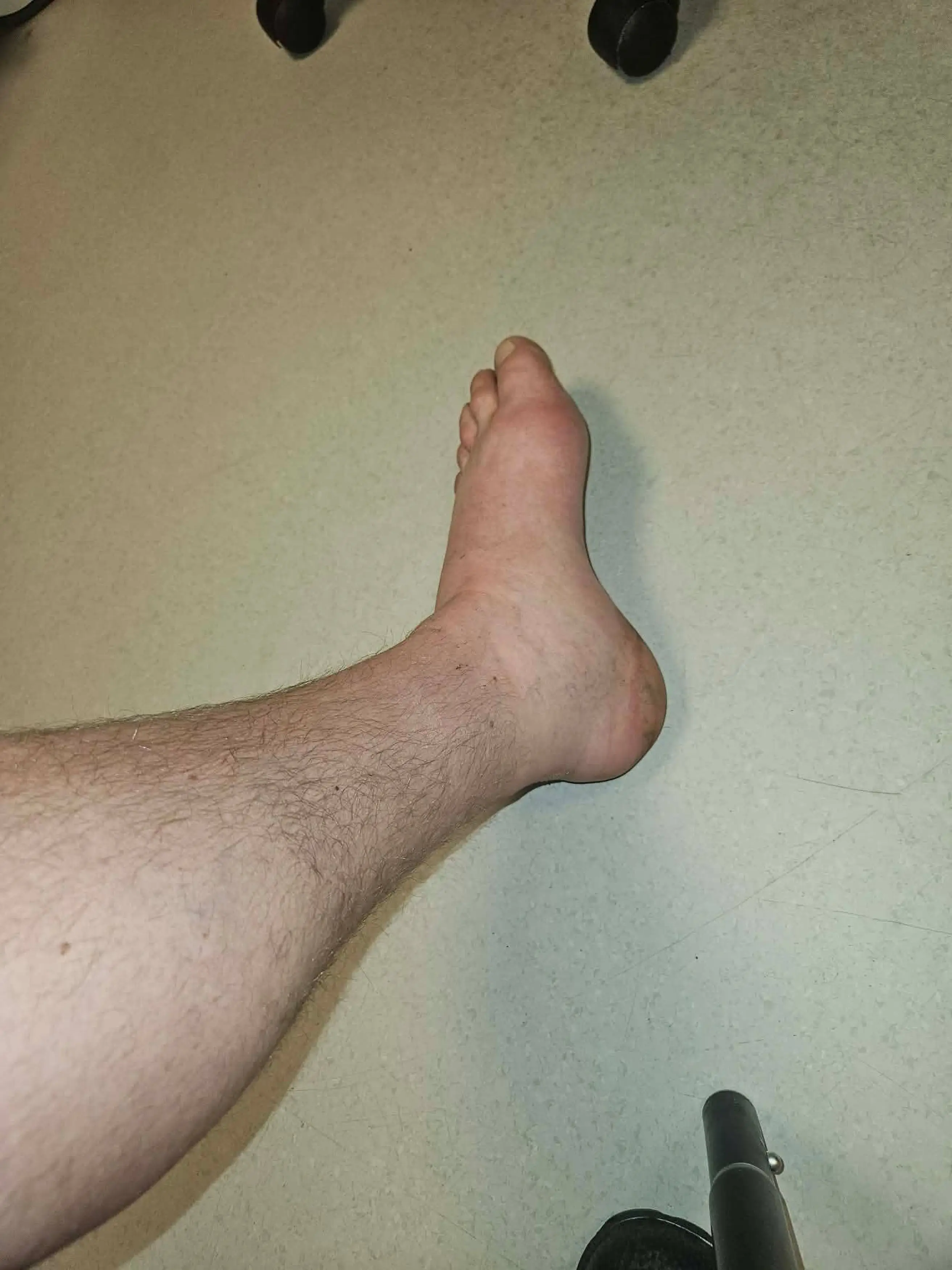 Zak's foot swelled up after the bite (Kennedy Media)