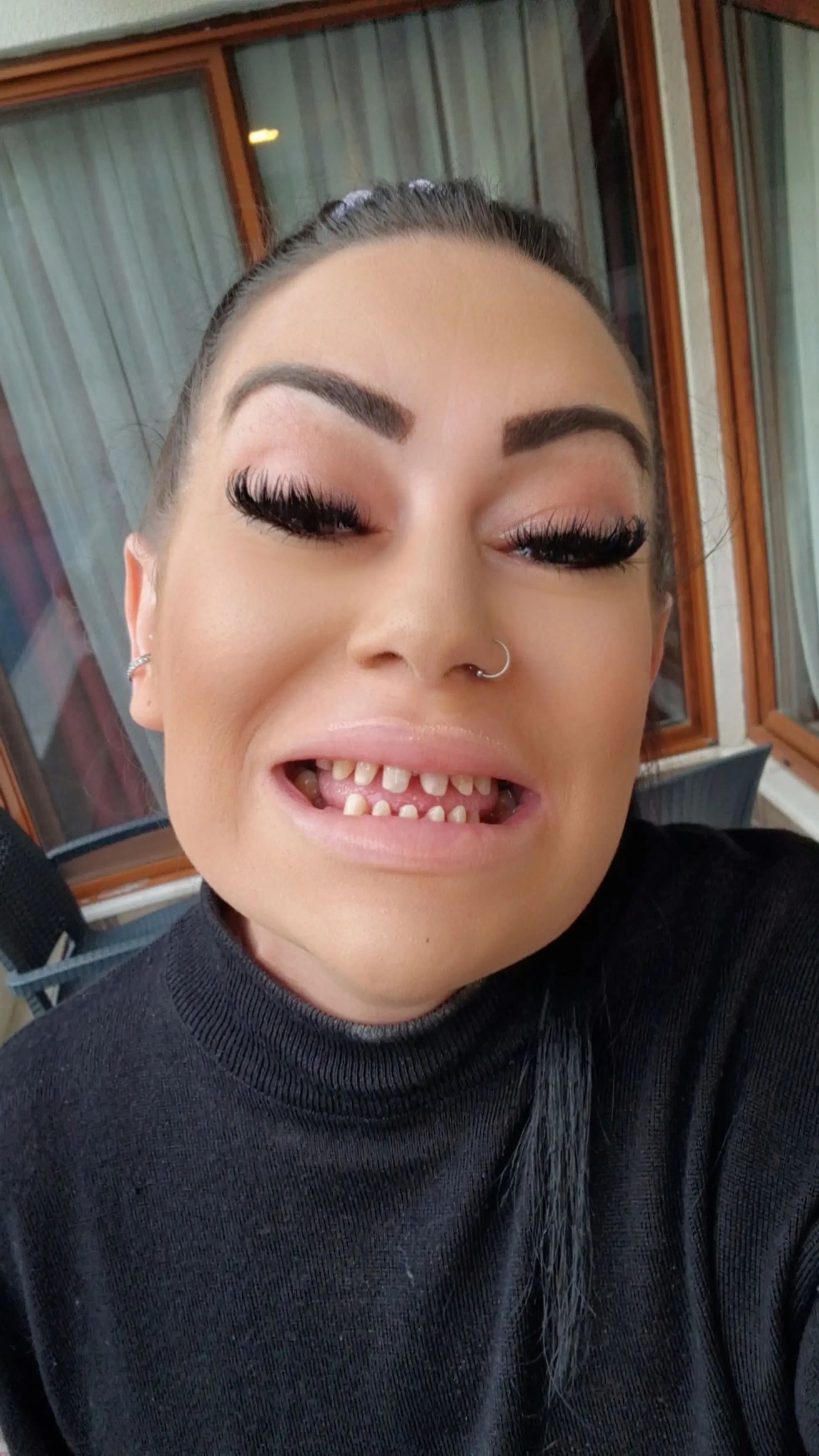 After the initial composite bonding failed, Jackie was given dental crowns before ending up needing her teeth removed (Kennedy News and Media)