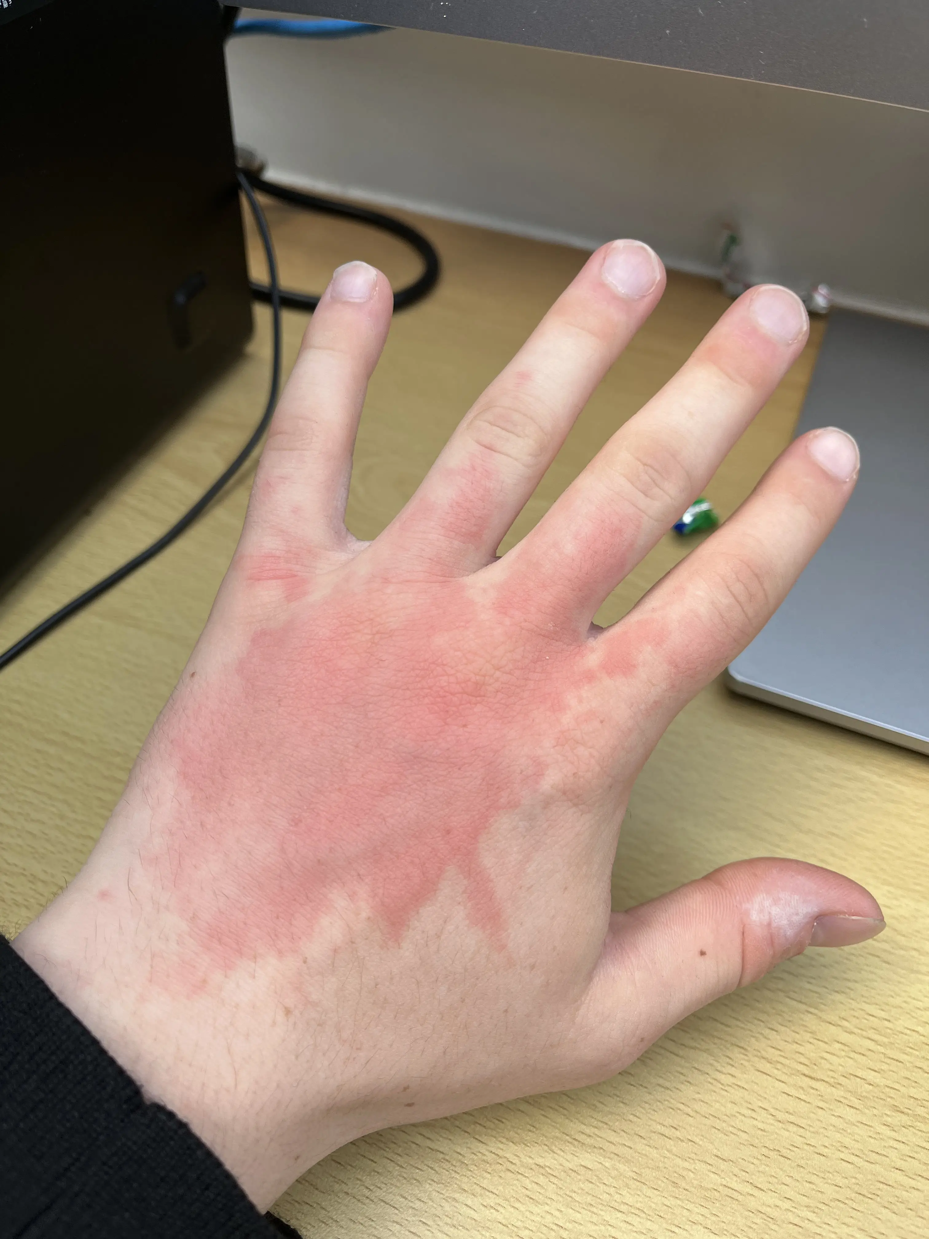 Ross didn't think much of the burn at first. (Pen News)