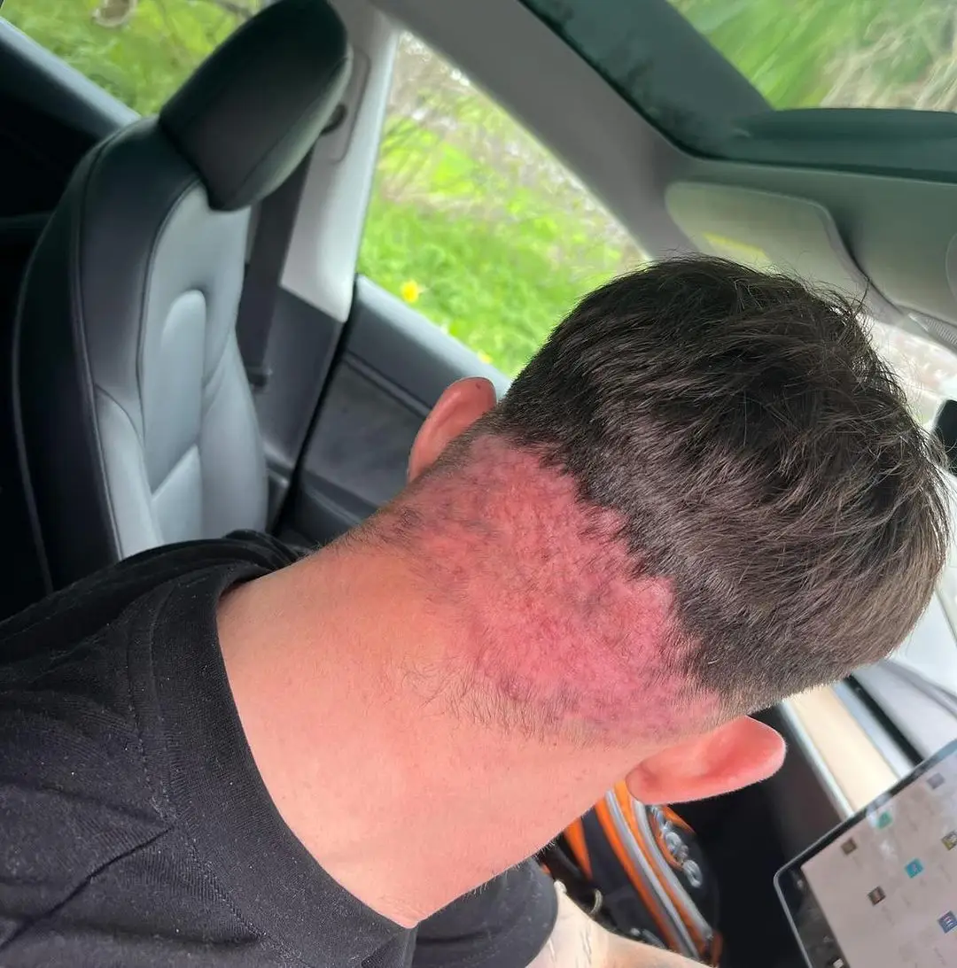 If not treated, the skin condition can cause permanent hair loss with scarring. (Instagram/@gazbeadle)
